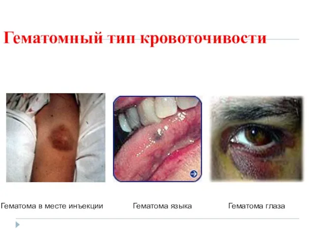 Гематомный тип кровоточивости Гематома в месте инъекции Гематома языка Гематома глаза