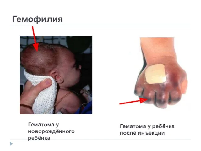 Гемофилия Гематома у новорождённого ребёнка Гематома у ребёнка после инъекции