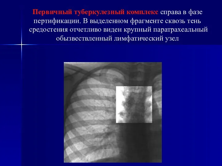 Первичный туберкулезный комплекс справа в фазе пертификации. В выделенном фрагменте