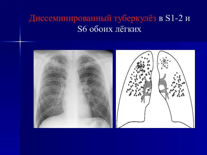 Диссеминированный туберкулёз в S1-2 и S6 обоих лёгких