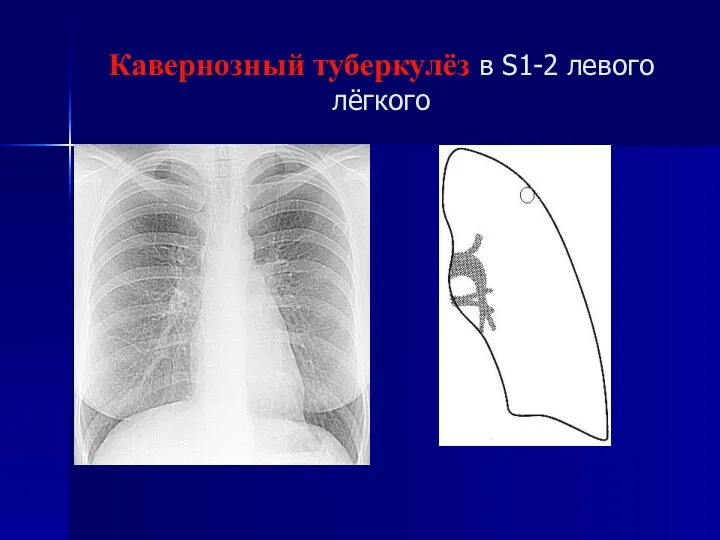 Кавернозный туберкулёз в S1-2 левого лёгкого