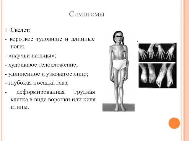 Симптомы Скелет: - короткое туловище и длинные ноги; - «паучьи