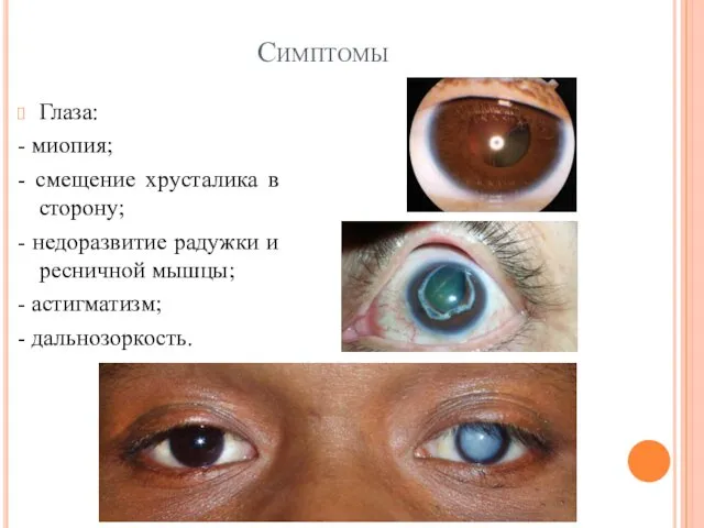 Симптомы Глаза: - миопия; - смещение хрусталика в сторону; -