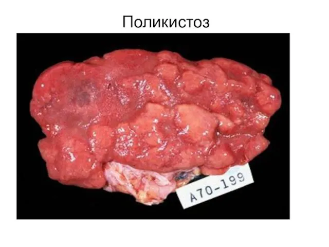 Поликистоз