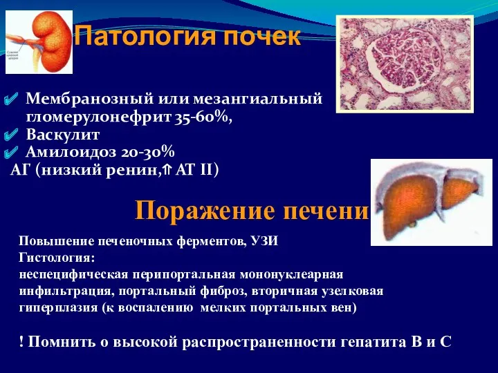 Патология почек Мембранозный или мезангиальный гломерулонефрит 35-60%, Васкулит Амилоидоз 20-30%