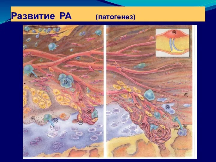 Развитие РА (патогенез)