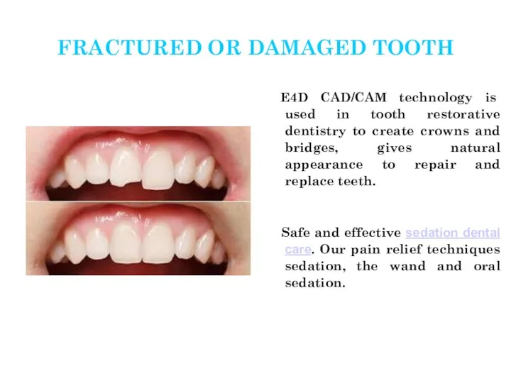 FRACTURED OR DAMAGED TOOTH E4D CAD/CAM technology is used in