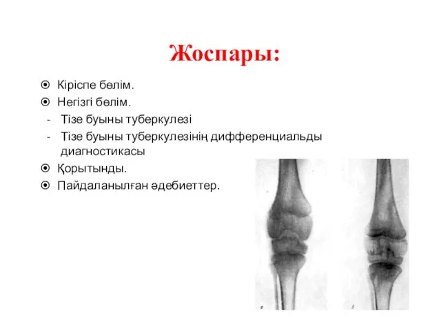 Жоспары: Кіріспе бөлім. Негізгі бөлім. Тізе буыны туберкулезі Тізе буыны туберкулезінің дифференциальды диагностикасы Қорытынды. Пайдаланылған әдебиеттер.