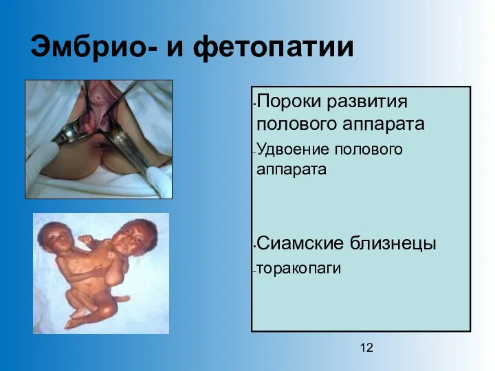 Эмбрио- и фетопатии Пороки развития полового аппарата Удвоение полового аппарата Сиамские близнецы торакопаги