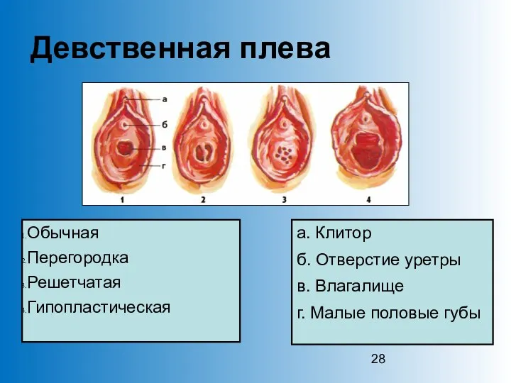 Девственная плева Обычная Перегородка Решетчатая Гипопластическая а. Клитор б. Отверстие