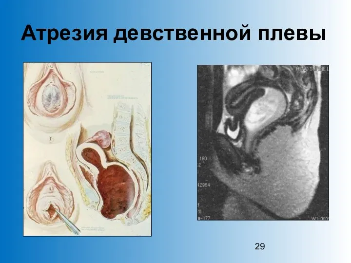 Атрезия девственной плевы