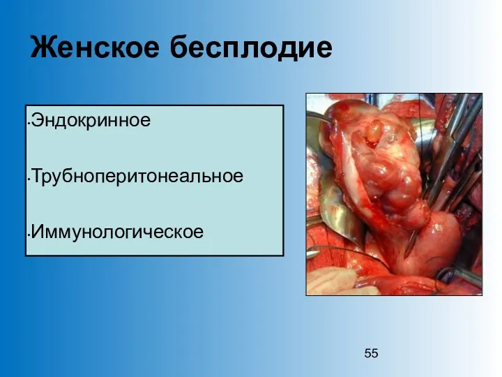 Женское бесплодие Эндокринное Трубноперитонеальное Иммунологическое