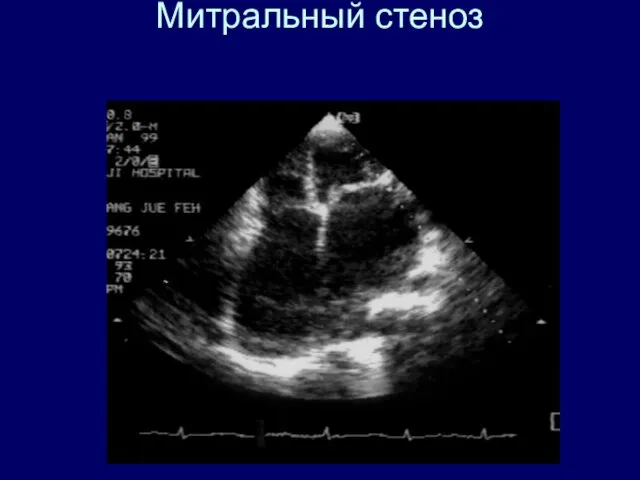 Митральный стеноз