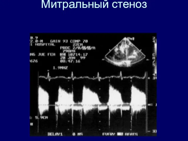 Митральный стеноз