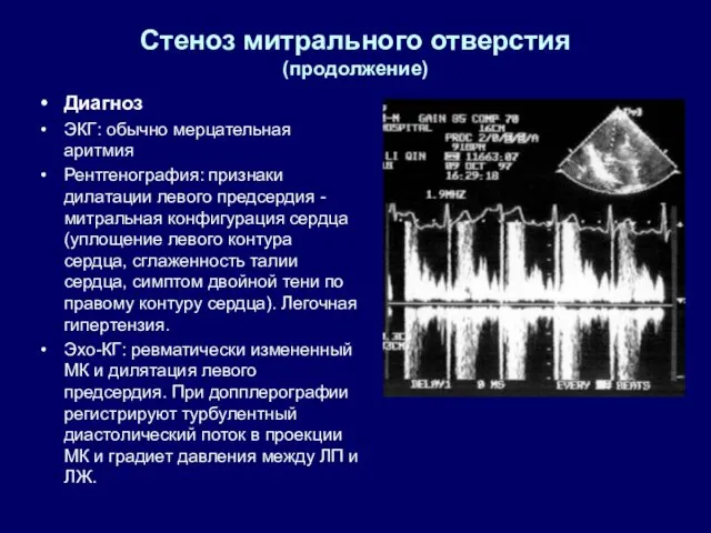 Стеноз митрального отверстия (продолжение) Диагноз ЭКГ: обычно мерцательная аритмия Рентгенография: признаки дилатации левого