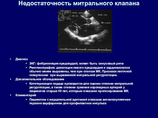 Недостаточность митрального клапана Диагноз ЭКГ: фибрилляция предсердий, может быть синусовый ритм Рентгенография: дилатация