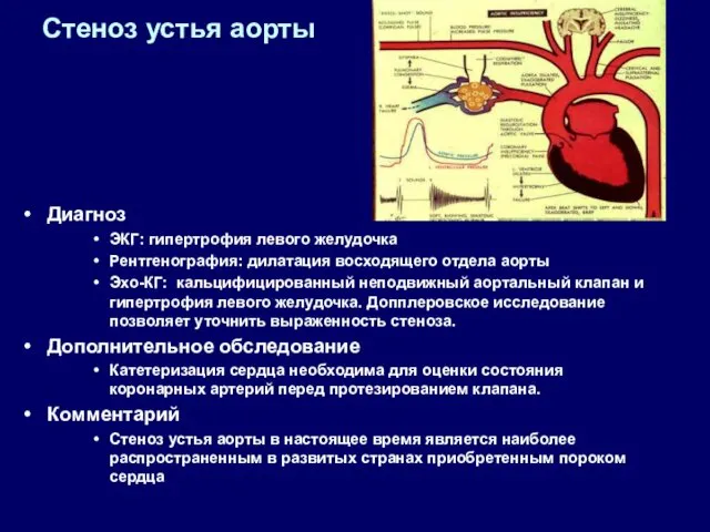 Стеноз устья аорты Диагноз ЭКГ: гипертрофия левого желудочка Рентгенография: дилатация восходящего отдела аорты