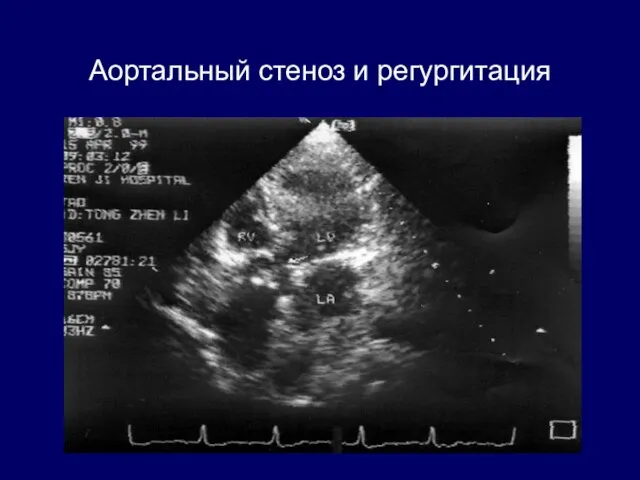 Аортальный стеноз и регургитация