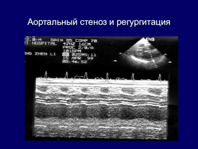 Аортальный стеноз и регургитация