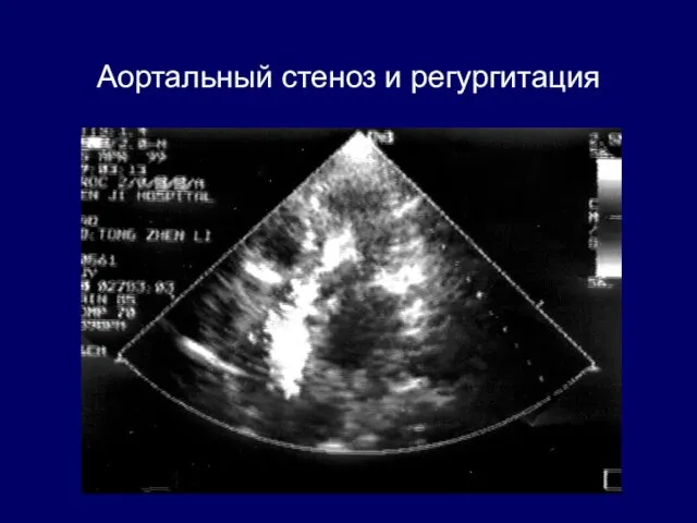 Аортальный стеноз и регургитация