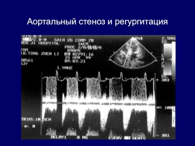 Аортальный стеноз и регургитация