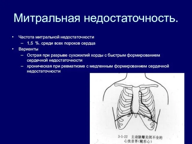 Митральная недостаточность. Частота митральной недостаточности 1,5 %. среди всех пороков сердца Варианты Острая