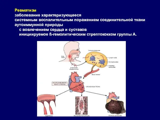 Ревматизм заболевание характеризующееся системным воспалительным поражением соединительной ткани аутоиммунной природы с вовлечением сердца