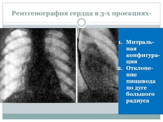 Рентгенография сердца в 3-х проекциях- Митраль-ная конфигура-ция Отклоне-ние пищевода по дуге большого радиуса