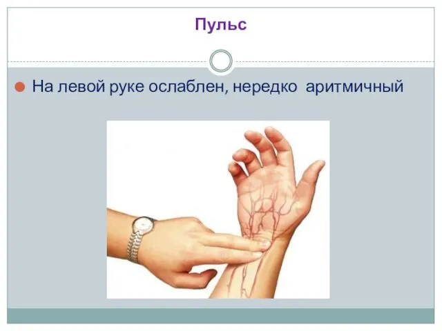 Пульс На левой руке ослаблен, нередко аритмичный