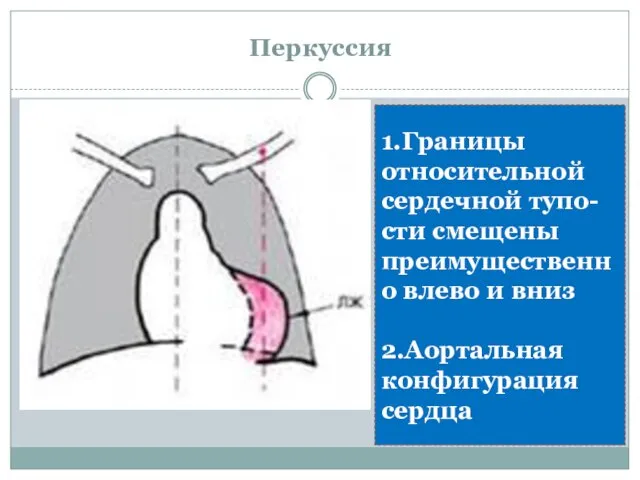 Перкуссия 1.Границы относительной сердечной тупо-сти смещены преимущественно влево и вниз 2.Аортальная конфигурация сердца