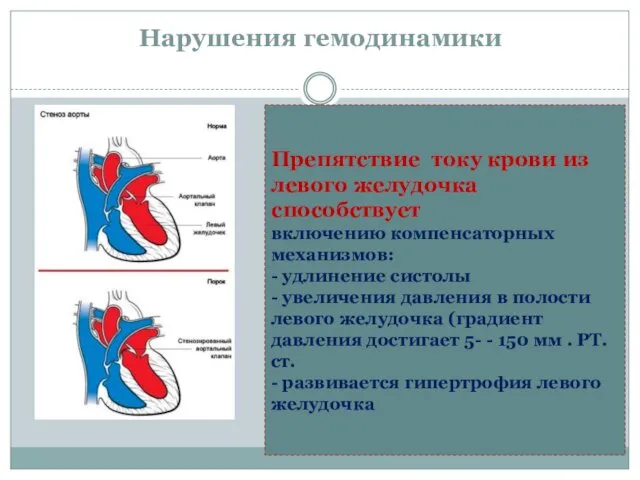 Нарушения гемодинамики Препятствие току крови из левого желудочка способствует включению