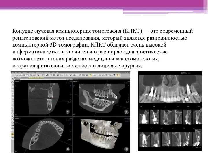 Конусно-лучевая компьютерная томография (КЛКТ) — это современный рентгеновский метод исследования,