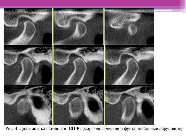 Рис. 4. Диагностика патологии ВНЧС (морфологические и функциональные нарушения)