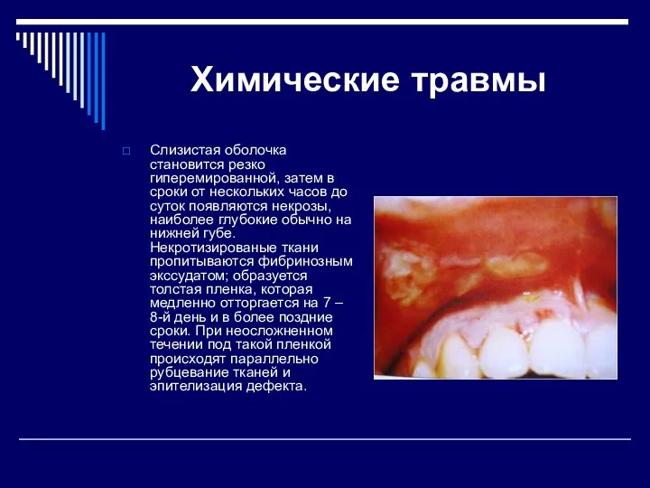 Химические травмы Слизистая оболочка становится резко гиперемированной, затем в сроки от нескольких часов