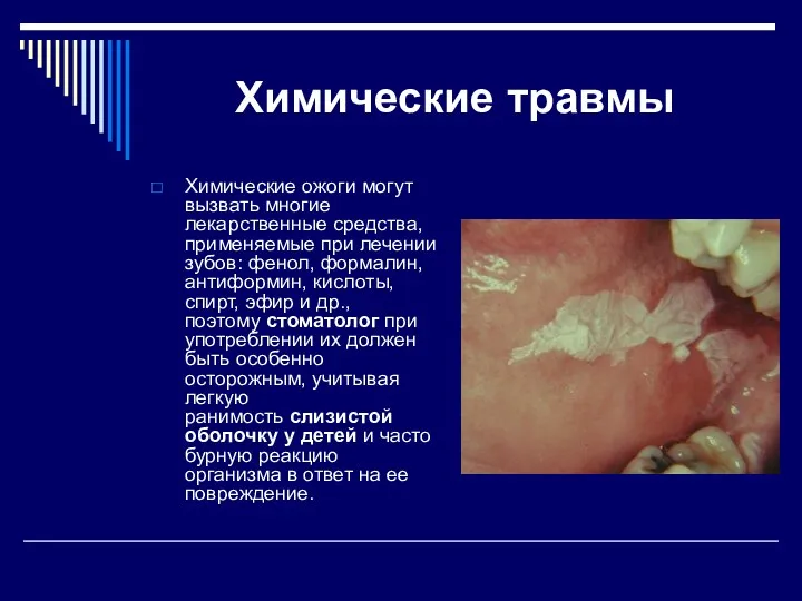 Химические травмы Химические ожоги могут вызвать многие лекарственные средства, применяемые при лечении зубов: