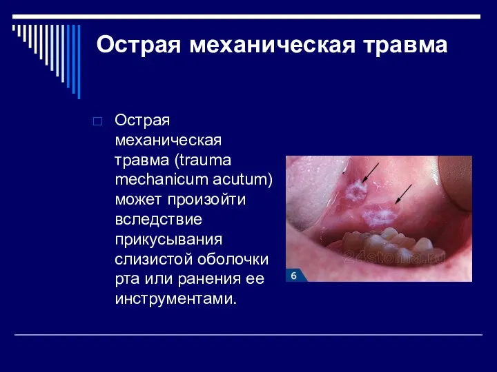 Острая механическая травма Острая механическая травма (trauma mechanicum acutum) может произойти вследствие прикусывания