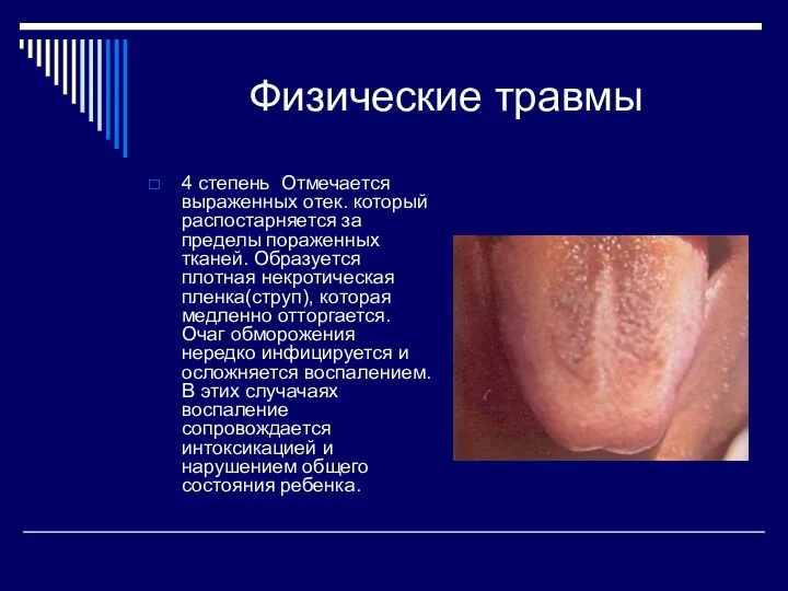 Физические травмы 4 степень Отмечается выраженных отек. который распостарняется за пределы пораженных тканей.