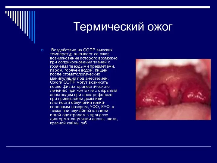 Термический ожог Воздействие на СОПР высоких температур вызывает ее ожог, возникновение которого возможно