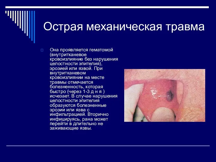 Острая механическая травма Она проявляется гематомой (внутритканевое кровоизлияние без нарушения целостности эпителия), эрозией