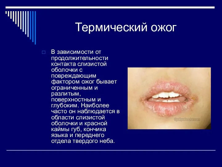 Термический ожог В зависимости от продолжительности контакта слизистой оболочки с повреждающим фактором ожог