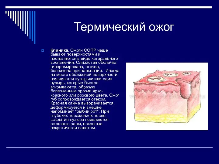 Термический ожог Клиника. Ожоги СОПР чаще бывают поверхностями и проявляются в виде катарального