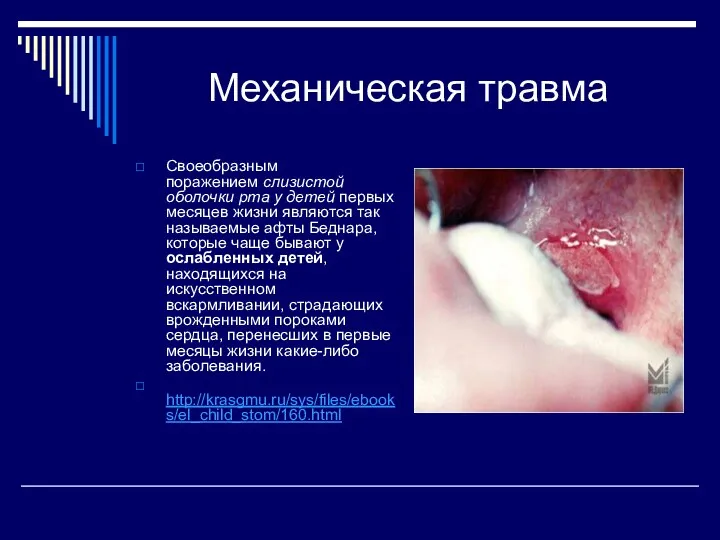 Механическая травма Своеобразным поражением слизистой оболочки рта у детей первых месяцев жизни являются