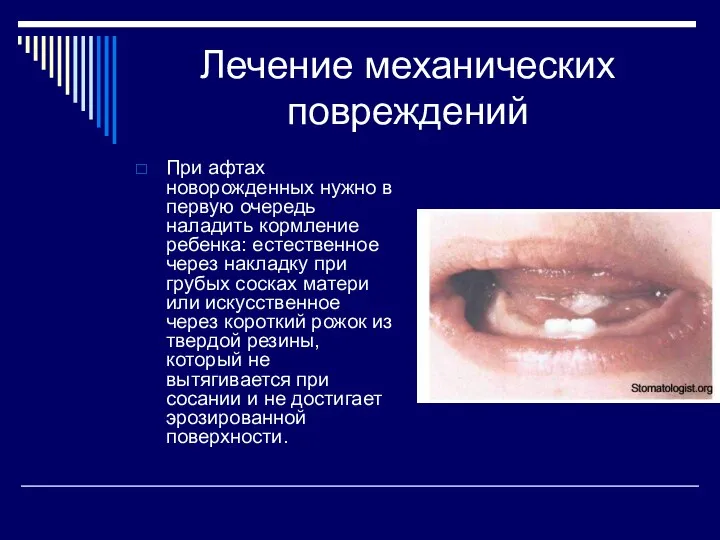 Лечение механических повреждений При афтах новорожденных нужно в первую очередь наладить кормление ребенка: