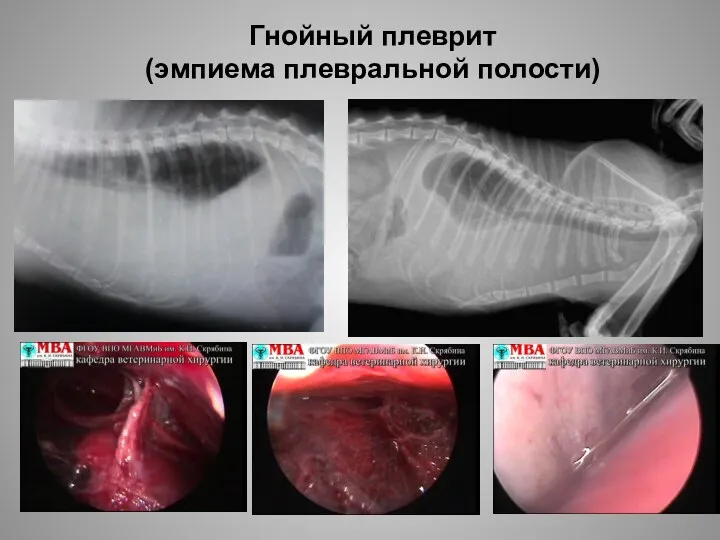 Гнойный плеврит (эмпиема плевральной полости)