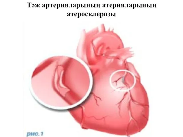 Тәж артерияларының атерияларының атеросклерозы