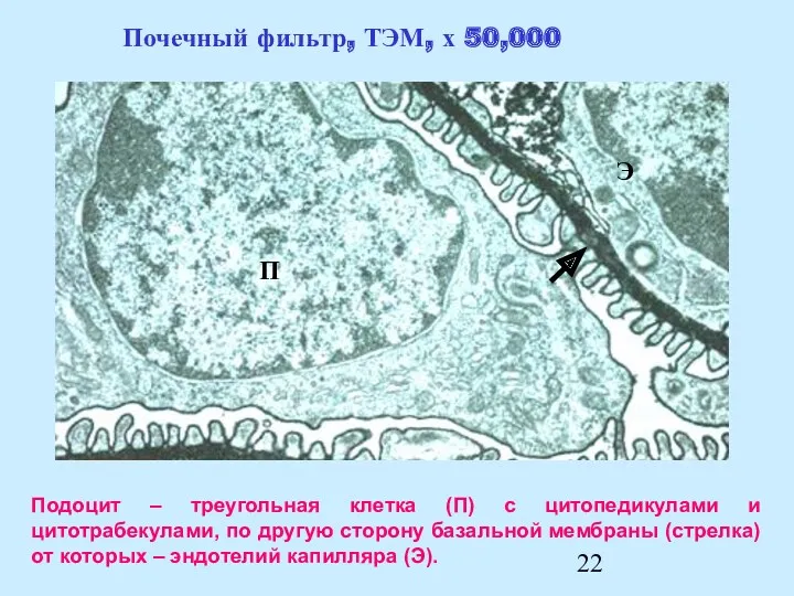 Подоцит – треугольная клетка (П) с цитопедикулами и цитотрабекулами, по