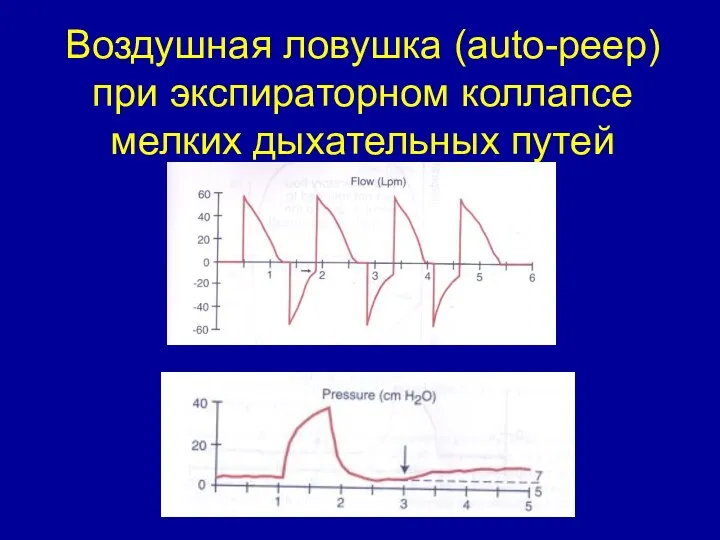 Воздушная ловушка (auto-peep) при экспираторном коллапсе мелких дыхательных путей