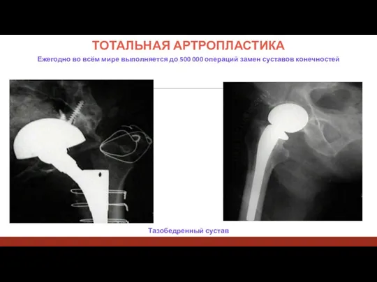 ТОТАЛЬНАЯ АРТРОПЛАСТИКА Ежегодно во всём мире выполняется до 500 000 операций замен суставов конечностей Тазобедренный сустав