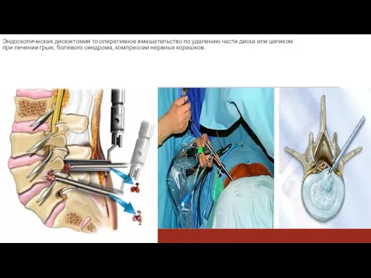Эндоскопическая дискэктомия то оперативное вмешательство по удалению части диска или