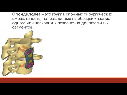 Спондилодез – это группа сложных хирургических вмешательств, направленных на обездвиживание одного или нескольких позвоночно-двигательных сегментов.